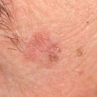 ESTATE : ATTENTI ALLA CHERATOSI ATTINICA